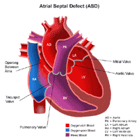 Click Image to Enlarge Anatomy of a heart with an atrial septal defect