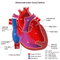 Haga clic en la imagen para ampliarla Anatomía de un corazón con una comunicación aurículoventricular