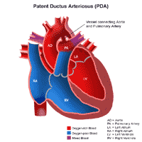 Click Image to Enlarge Anatomy of a heart with a patent ductus arteriosus