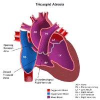 Click Image to Enlarge Anatomy of a heart with tricuspid atresia