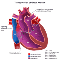 Click Image to Enlarge Anatomy of a heart with transposition of the great arteries