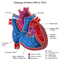 Click Image to Enlarge Anatomy of a heart with tetralogy of Fallot