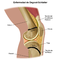 Haga clic en la imagen para agrandarla Ilustración de la enfermedad de Osgood-Schlatter