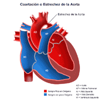 Haga clic en la imagen para ampliarla Anatomía de un corazón con conducto con coartación de la aorta