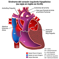 Haga clic en la imagen para ampliarla. Anatomía de un corazón con síndrome del corazón izquierdo hipoplástico