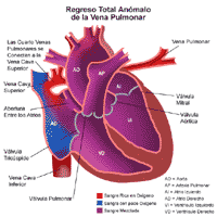 Haga clic en la imagen para ampliarla. Anatomía de un corazón con drenaje venoso pulmonar anómalo total