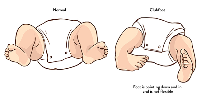 Clubfoot illustration