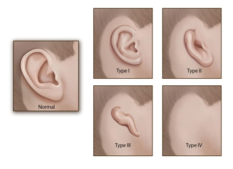 four grades of microtia