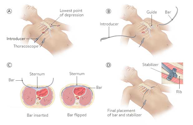 Nuss procedure - pectus excavatum surgery, what is pectus excavatum