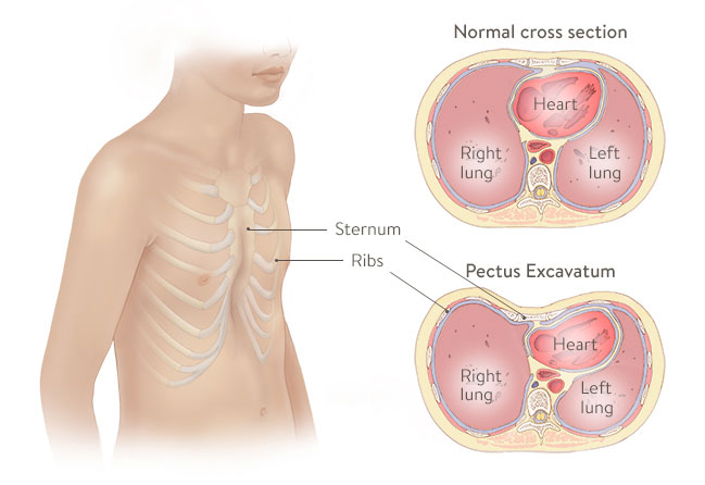 Pectus excavatum