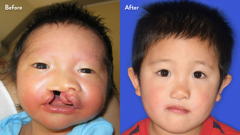 Before and after of boy with cleft lip