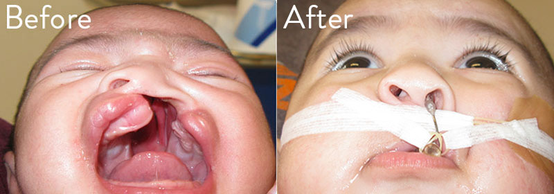 Patient 2 before and after nasoalveolar molding (NAM)