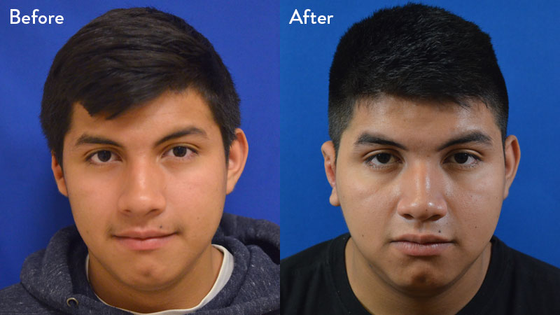 14-year-old-male with Grade 2-3 Microtia