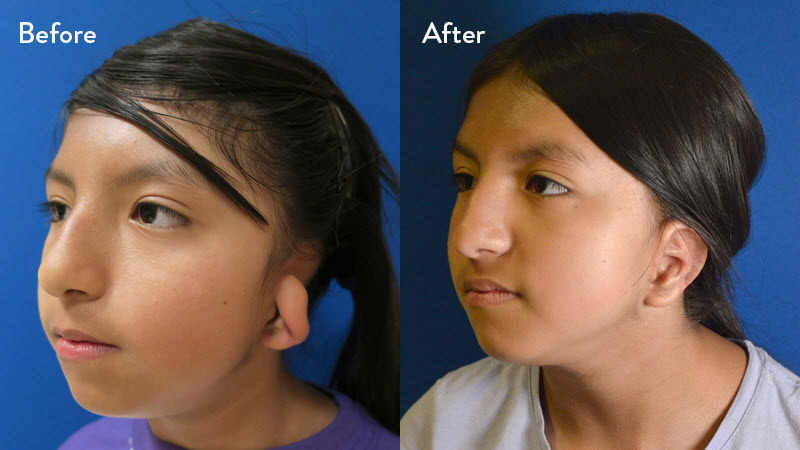 Grade 2 microtia before and after