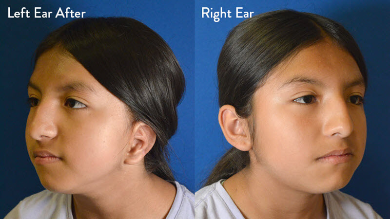 Microtia Grade 2 Female After