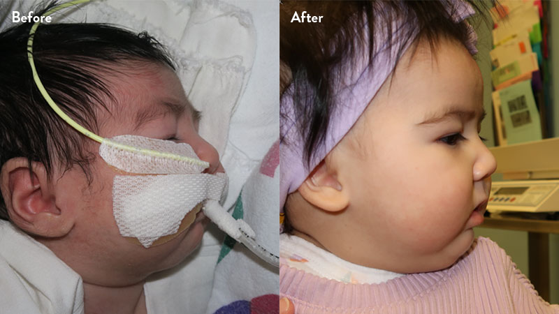 Before and after of infant with orthodontic airway plate treatment