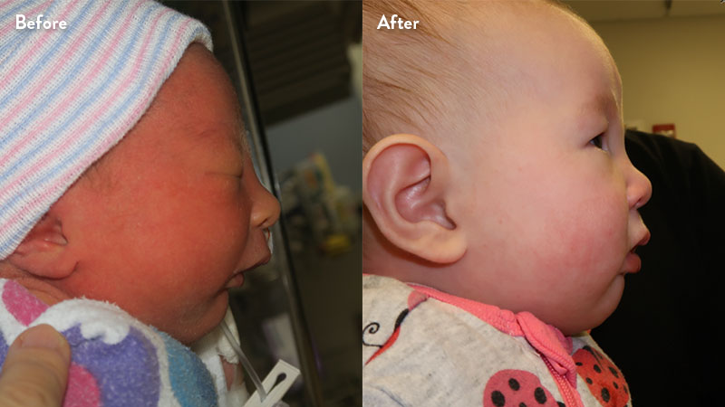 Before and after of infant with orthodontic airway plate treatment