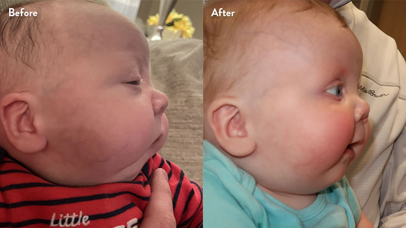 Before and after of infant with orthodontic airway plate treatment