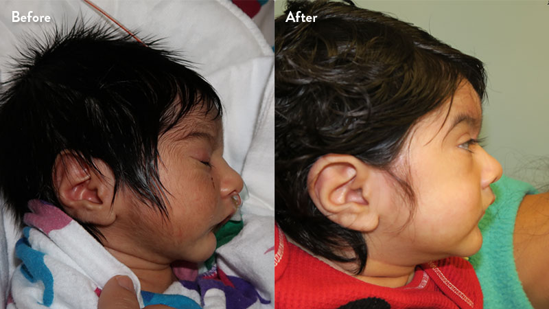 Before and after of infant with orthodontic airway plate treatment