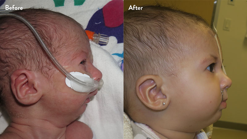 Before and after of infant with orthodontic airway plate treatment