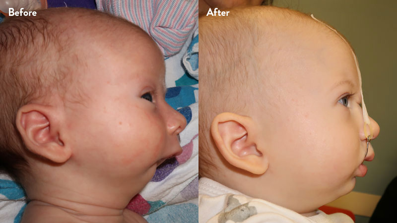 Before and after of infant with orthodontic airway plate treatment