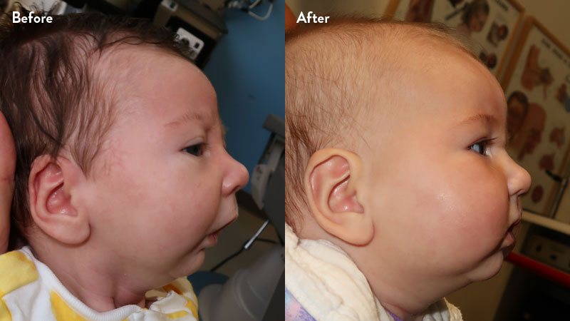 Before and after of infant with orthodontic airway plate treatment