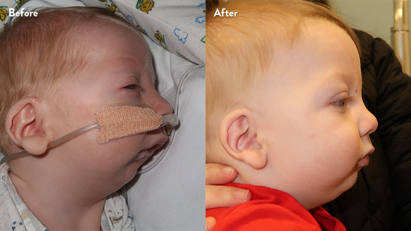 Before and after of infant with orthodontic airway plate treatment