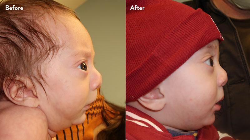 Before and after of infant with orthodontic airway plate treatment