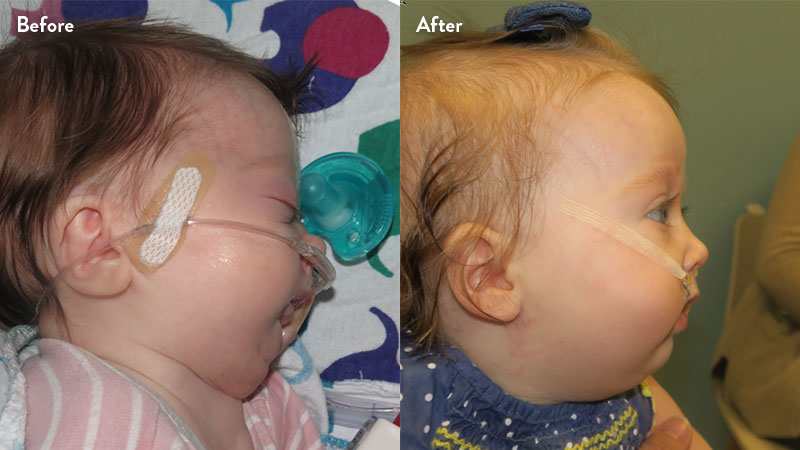 Before and after of infant with orthodontic airway plate treatment