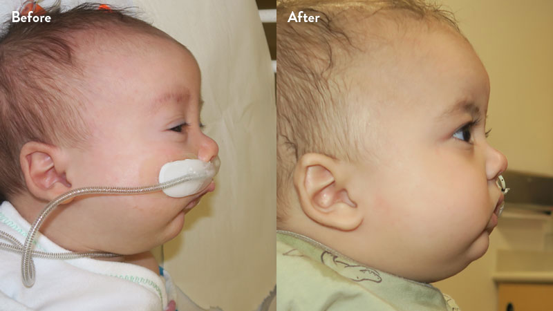 Before and after of infant with orthodontic airway plate treatment