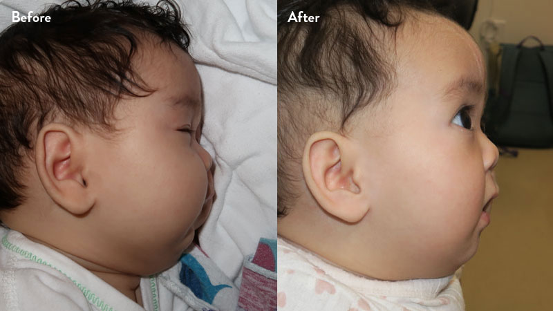 Before and after of infant with orthodontic airway plate treatment
