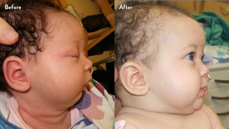 Before and after of infant with orthodontic airway plate treatment