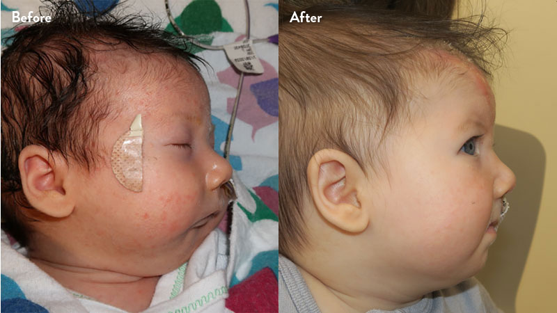 Before and after of infant with orthodontic airway plate treatment