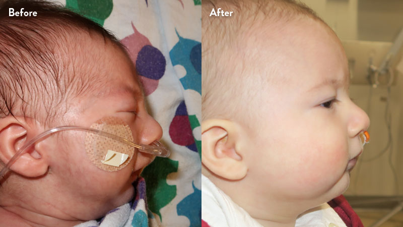 Before and after of infant with orthodontic airway plate treatment