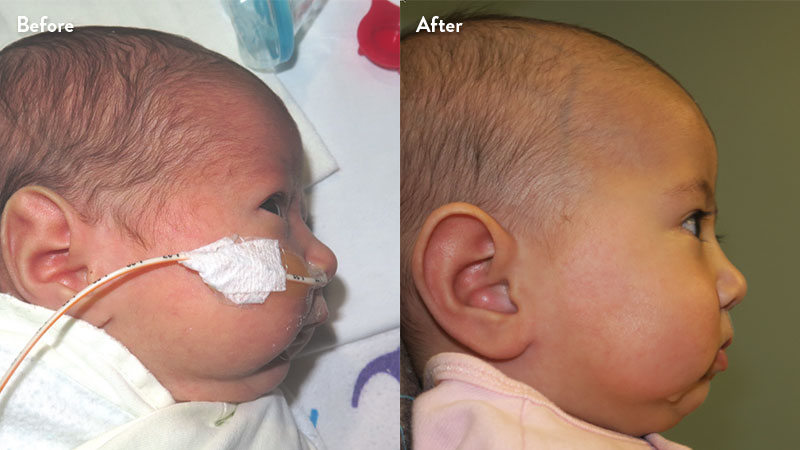 Before and after of infant with orthodontic airway plate treatment