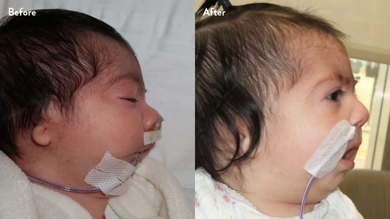 Before and after of infant with orthodontic airway plate treatment