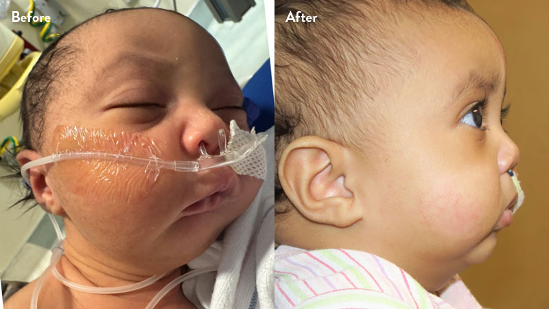 Before and after of infant with orthodontic airway plate treatment
