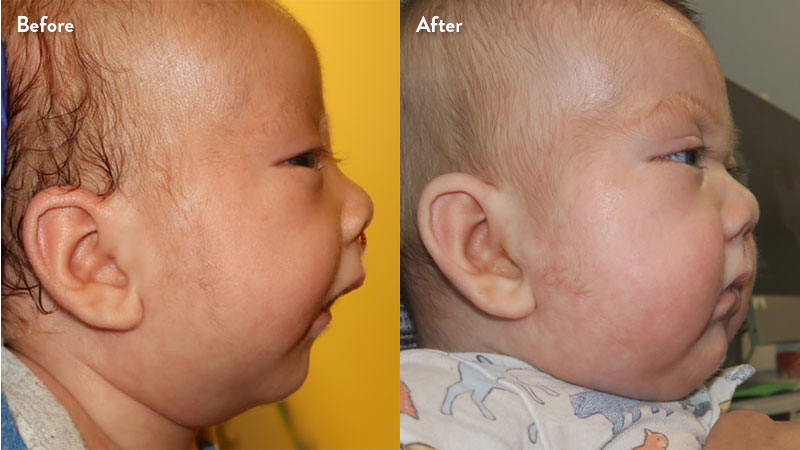 Before and after of infant with orthodontic airway plate treatment