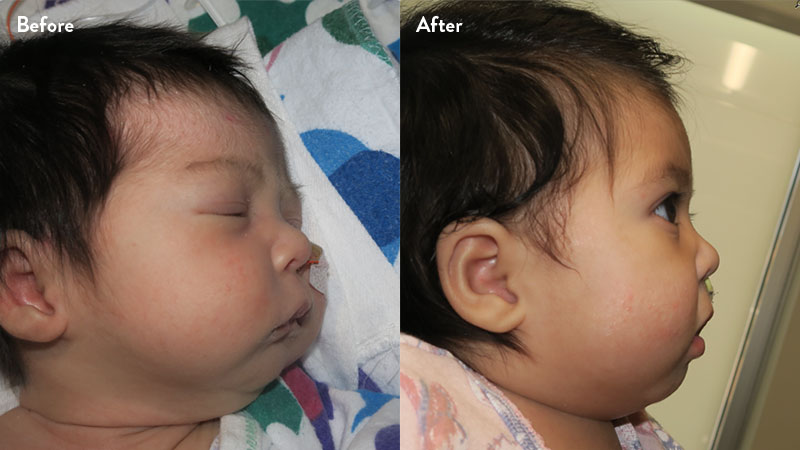 Before and after of infant with orthodontic airway plate treatment