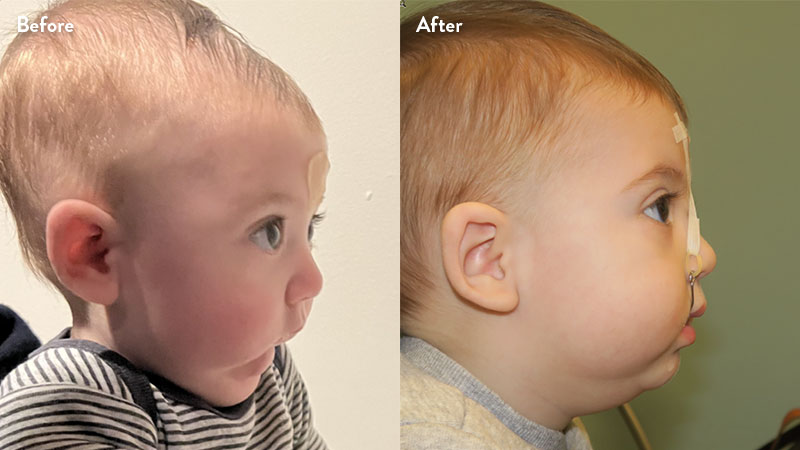 Before and after of infant with orthodontic airway plate treatment